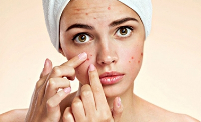 10 روش  برای درمان جوش‌های سرسفید صورت (قسمت اول)